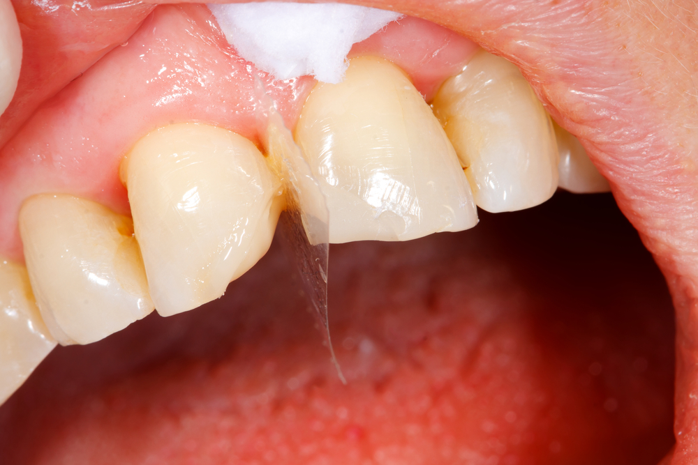 Cracked Tooth Or Craze Lines Natural Treatment