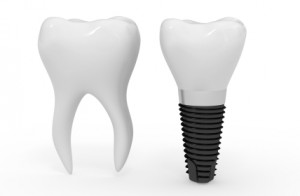 iStock_000014314701XSmall dental implant