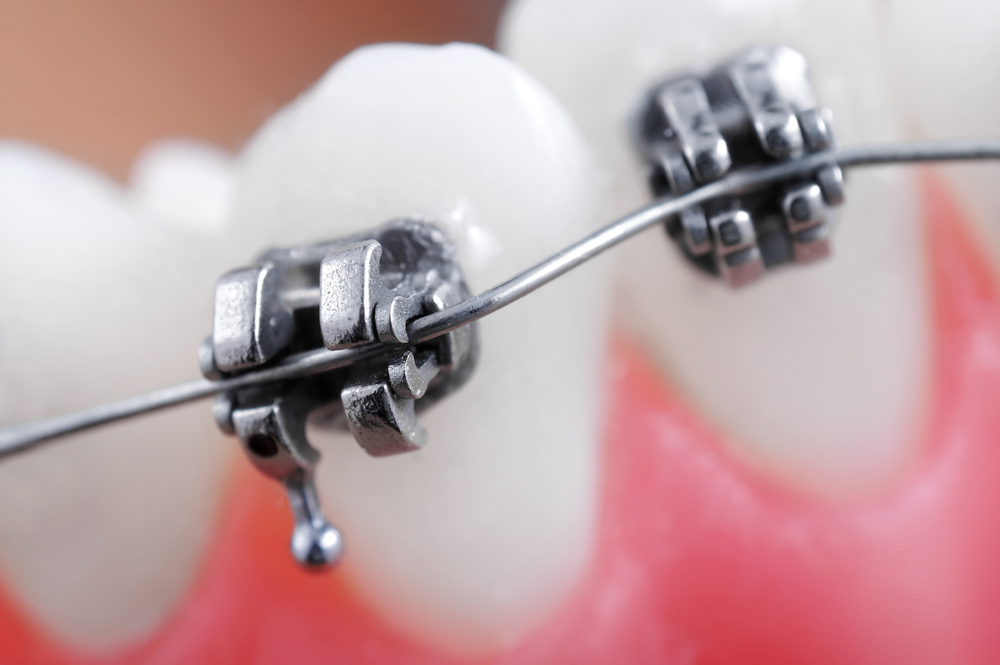 Orthodontic Bracket Slot Size Does It Influence Treatment Outcomes 9411