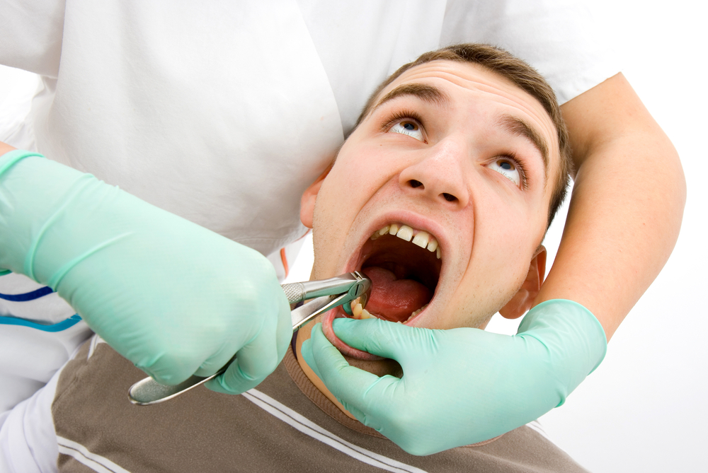 Icd 10 Code For Tooth Extraction Bleeding