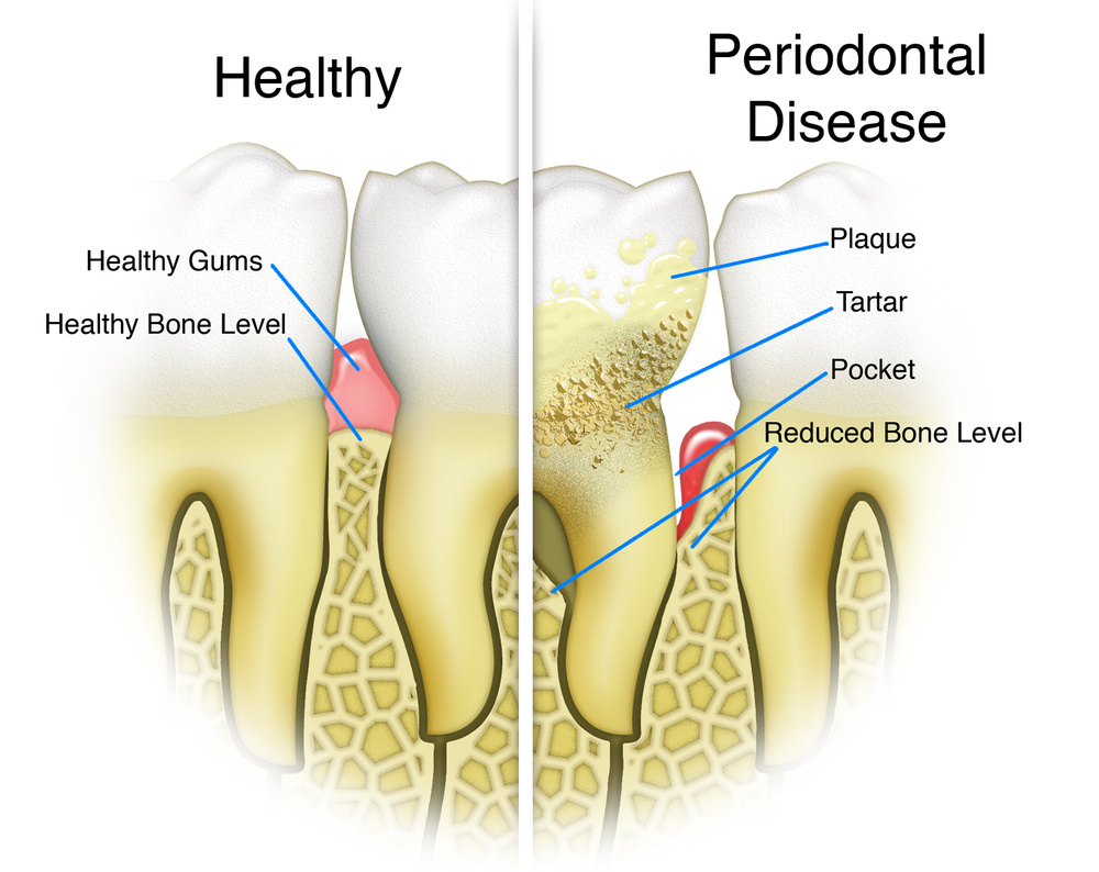 furcation-involvement-may-double-risk-of-tooth-loss-in-periodontitis