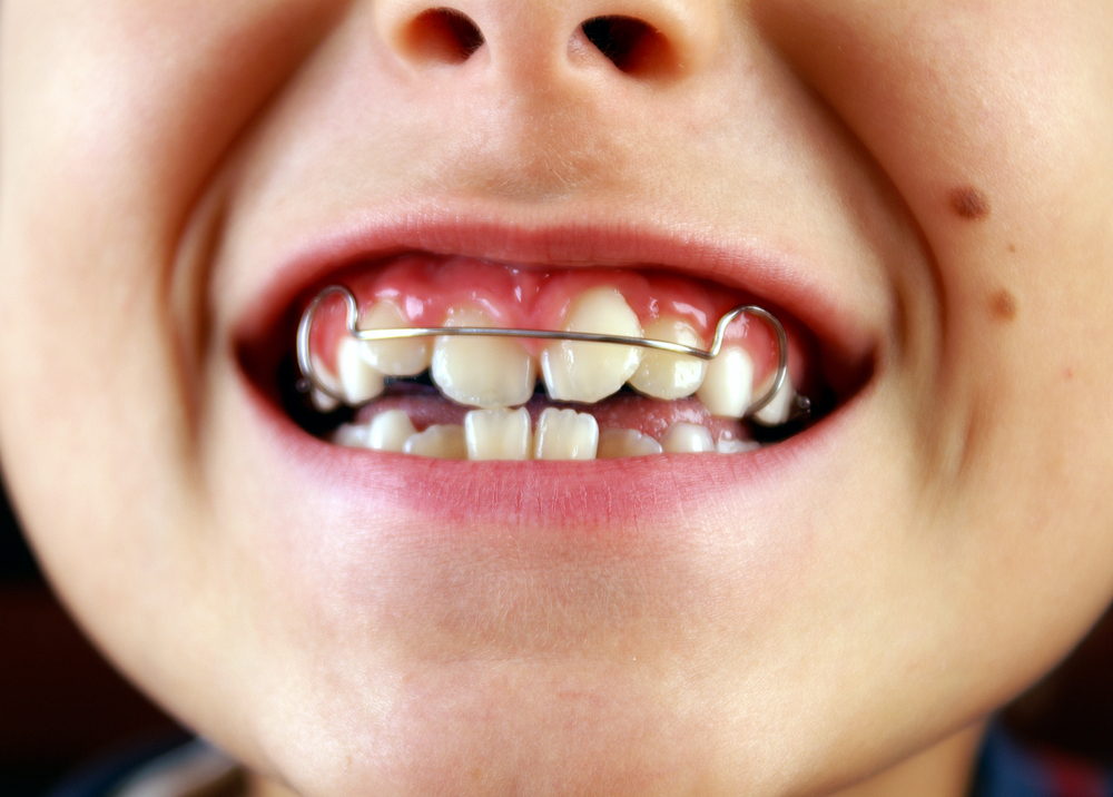 Tooth crowding in children: Which orthodontic intervention