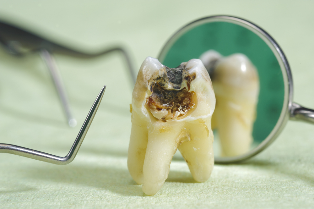 Can One Rotten Tooth Affect Others? Exploring the Connection Between Dental  Health and Overall Wellness