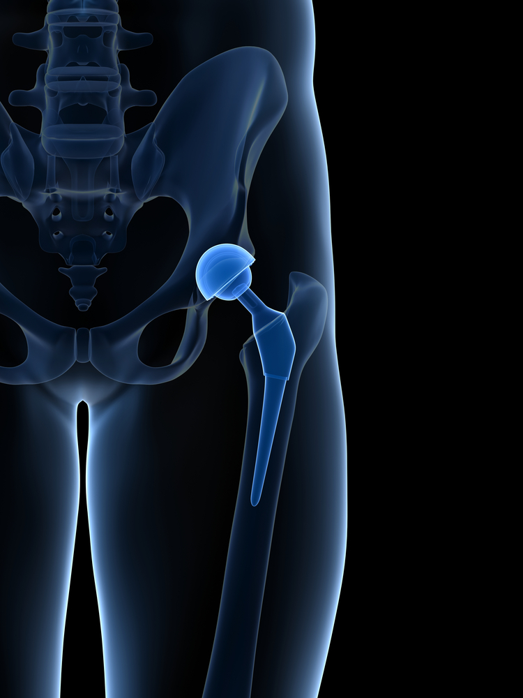 Health related quality of life after total hip replacement