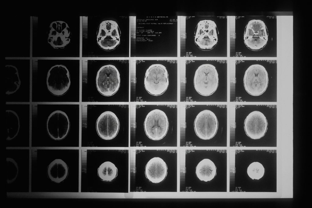 Brain scan images being held up against a viewer.